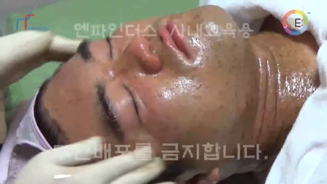 Ozone Peeling (ozonation oil) смотреть онлайн