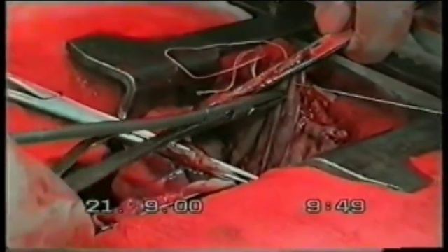 Chist hidatic pulmonar gigant - operatie смотреть онлайн