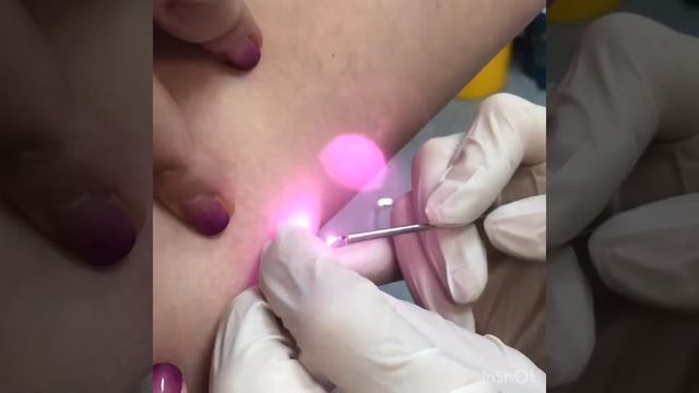 Удаление лазером образований на коже смотреть онлайн