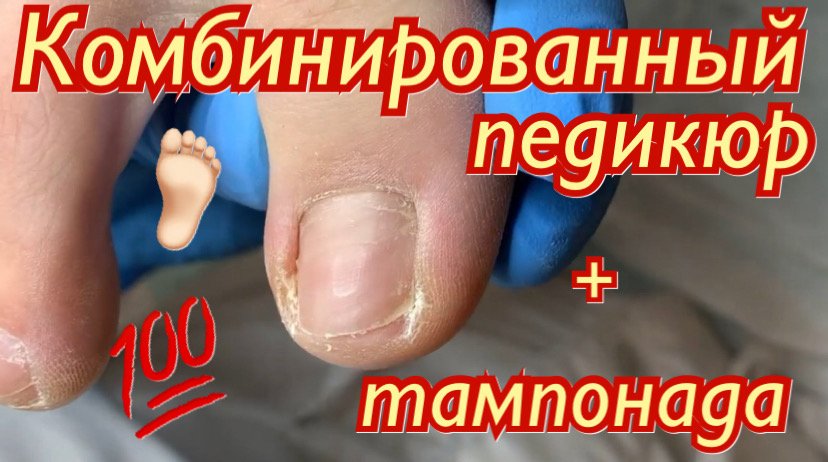 Комбинированный педикюр ??? + тампонада??? смотреть онлайн