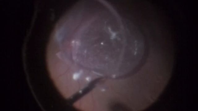 Dislocated IOL - Pars plana vitrectomy and IOL Exchange смотреть онлайн