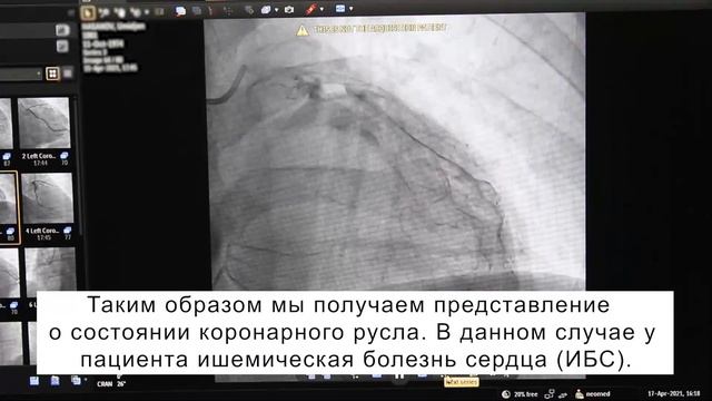 Ишемическая болезнь сердца на коронарографии. смотреть онлайн
