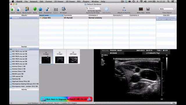 How to remove patient name from medical images on OsiriX смотреть онлайн