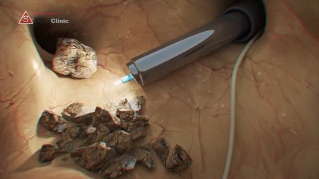 Удаление любых камней в почках, лечение мочекаменной болезни смотреть онлайн