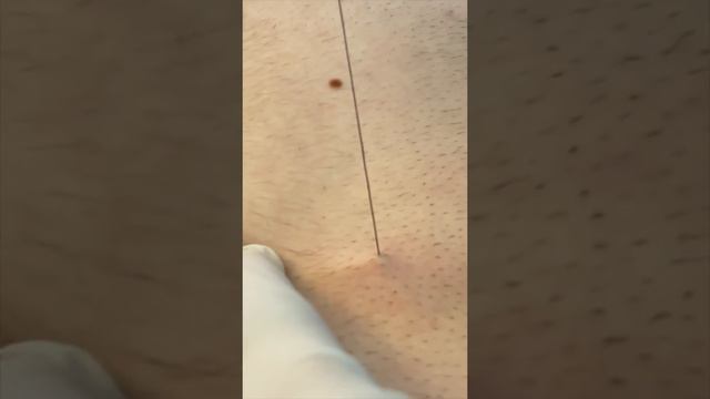 WORLD'S LONGEST INGROWN HAIR!