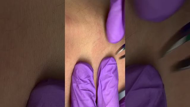 Электроэпиляция @po_volosku Apilus смотреть онлайн