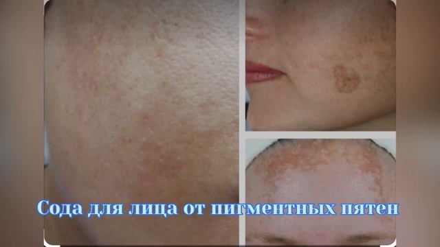 Сильнейшая Маска с Содой Против прыщей, пятен и черных точек??? смотреть онлайн