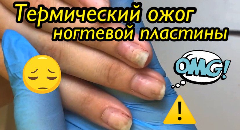 Термический ожог ногтевой пластины ?⚠️?? смотреть онлайн