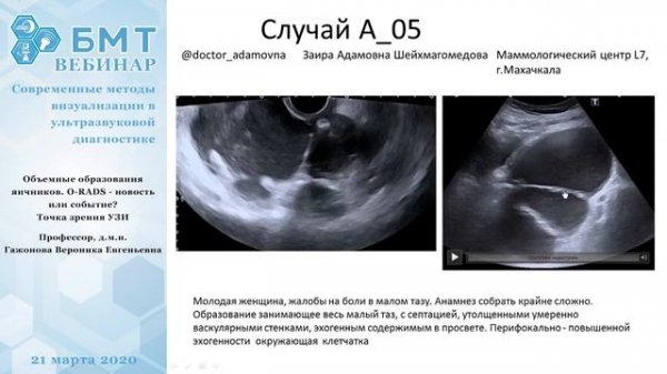 В.Е. Гажонова: Объемные образования яичников. RADS с точки зрения УЗИ