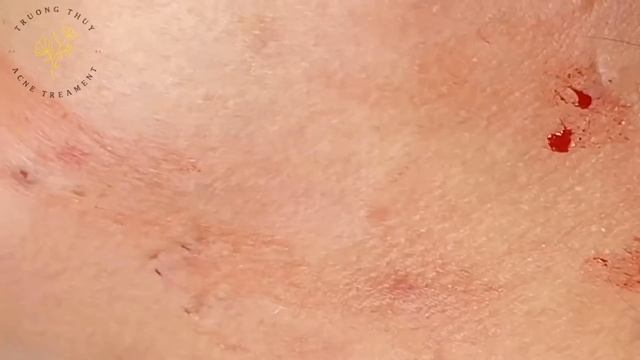 Acne Treament Under The Skin #039 смотреть онлайн