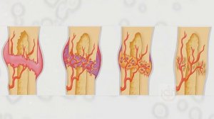 Сколько срастаются кости после перелома? Как именно срастаются кости после перелома?