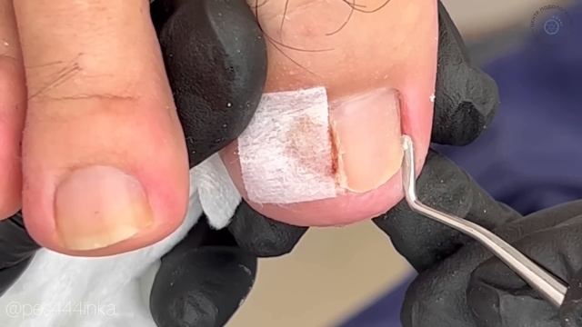 Ноготь после хирурга / вросший ноготь / подолог в москве