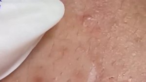 Relax squeezing out blackheads #43 Черные точки