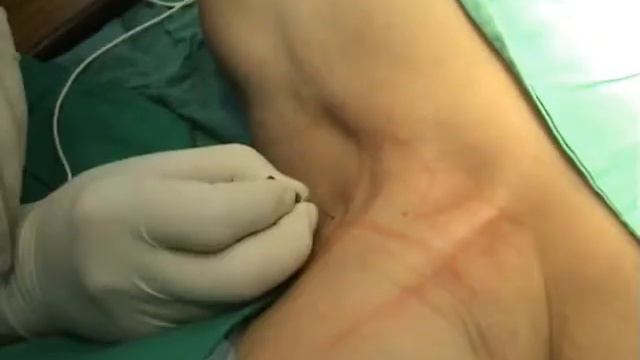 Блокада плечевого сплетения (межлестничный доступ) смотреть онлайн