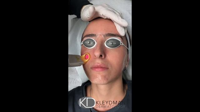 Excel V Laser To Treat Diffuse Redness смотреть онлайн