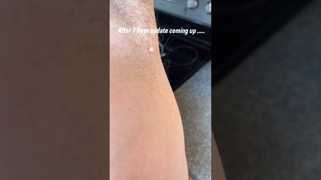 Dr. Scholl’s Skin Tag Remover | Application and After 7 day Results смотреть онлайн
