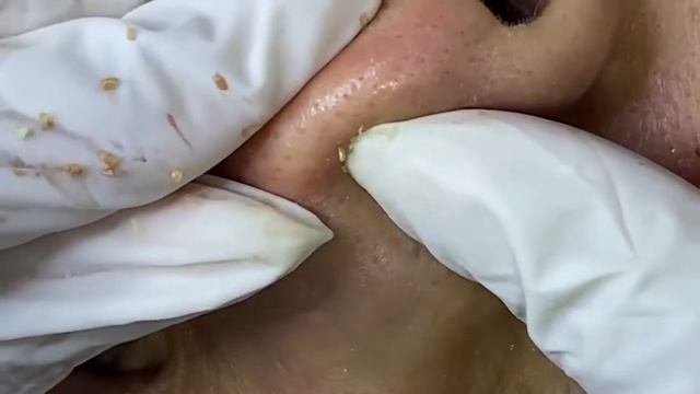 Relaxing Acne Treatment Acnes Treatment 78 смотреть онлайн