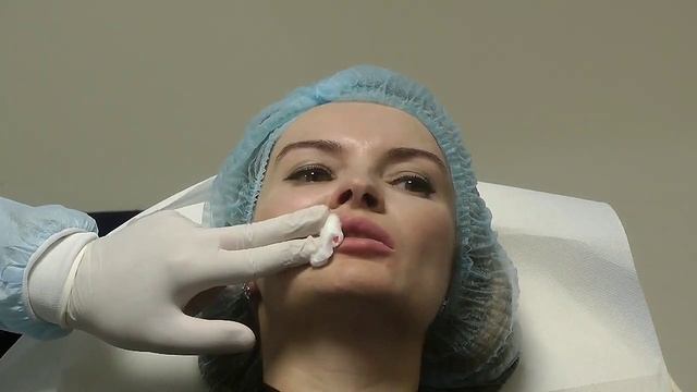 Увеличение губ филлерами Stylage, игла. Обучение косметологов. смотреть онлайн