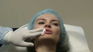 Увеличение губ филлерами Stylage, игла. Обучение косметологов.