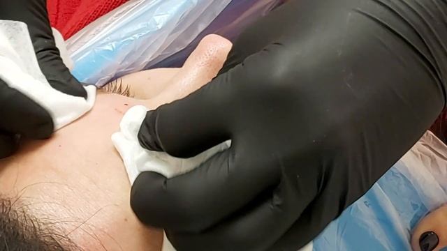 АирисКом студенты учатся: обучение ботокс. Выполнения ботокса в области лба и круговой мышцы глаза. смотреть онлайн