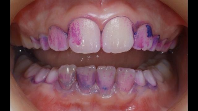 Профессиональная гигиена полости рта. Чистка зубов у стоматолога. Oral hygiene. смотреть онлайн