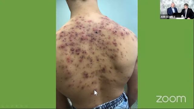 Акне. Современные принципы лечения смотреть онлайн