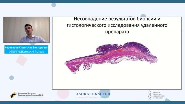 Чернышов Ранний рак прямой кишки смотреть онлайн