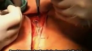 Срединная лапаротомия-median laparotomia