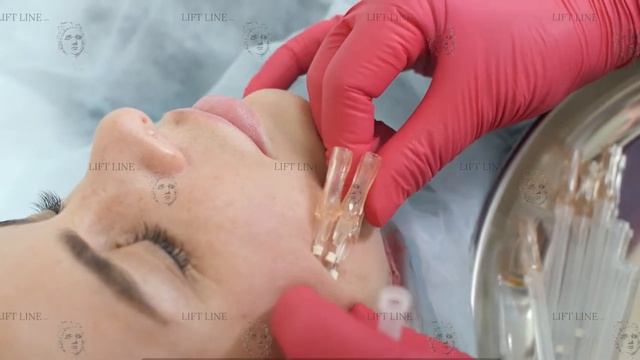 Коррекция овала лица нитями Lift Line Nata