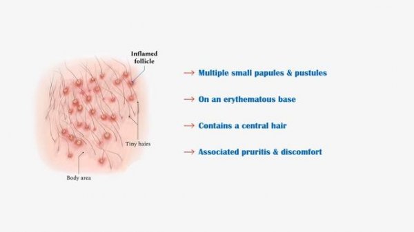 Folliculitis - Causes, Signs & Symptoms, Complications & Treatment