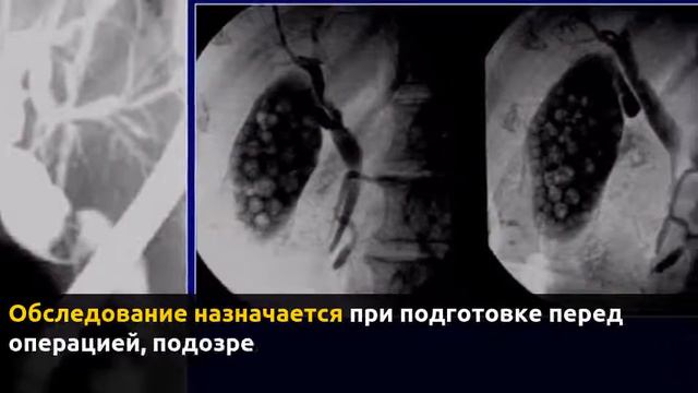 Холецистография