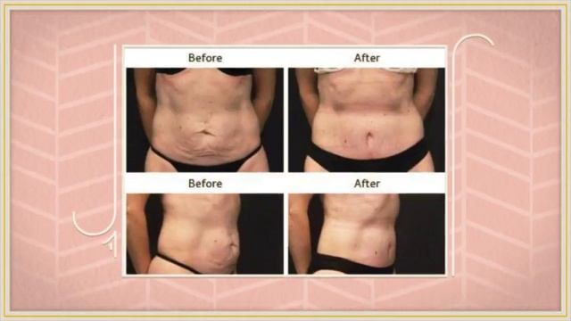 Tummy Tuck In Bellevue | cosmeticsurgeryforyou.com смотреть онлайн