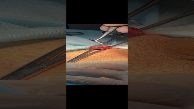 Операция по удалению варикоцеле. Уролог. Флеболог Москва смотреть онлайн