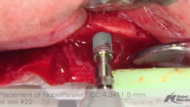 All-on-4® treatment concept clinical case: surgical procedure and denture conversion | Nobel Biocar смотреть онлайн