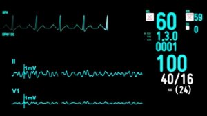 ECG monitor Экг монитор футаж Пульс сердца