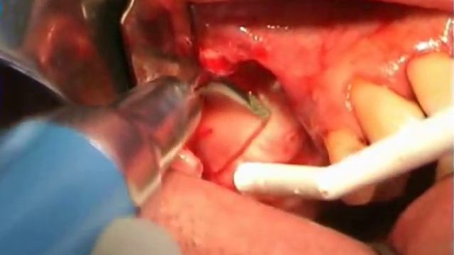 Sinus Lift смотреть онлайн