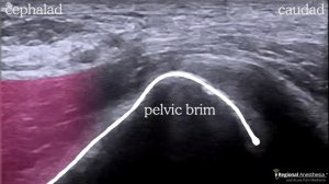 Fascia Iliaca Plane Block