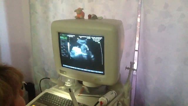 УЗИ 22 недели мальчик смотреть онлайн