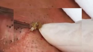 ОГРОМНЫЕ ЧЕРНЫЕ ТОЧКИ/BLACKHEAD Removal.Squeezing acne/RELAX SPA
