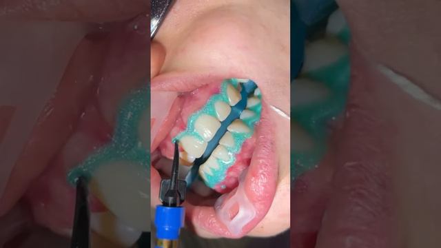 Отбеливание зубов OPALESCENCE BOOST