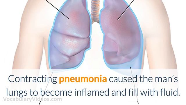 Learn English Words - PNEUMONIA - Meaning, Vocabulary Lesson With Pictures And Examples