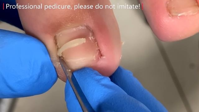 Very Large Ingrown Nail Removal Process, Shocking！【Xue Yidao】