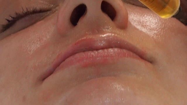 Мезопилинг фракционно и мануально (Часть 3) смотреть онлайн