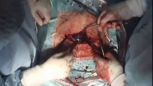 Видео: Использование Гемоблок при Кесаревом сечении (гемостаз Гемоблоком смотреть с 10-й минуты) смотреть онлайн