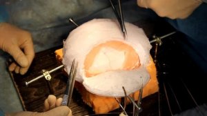 Трепанация черепа