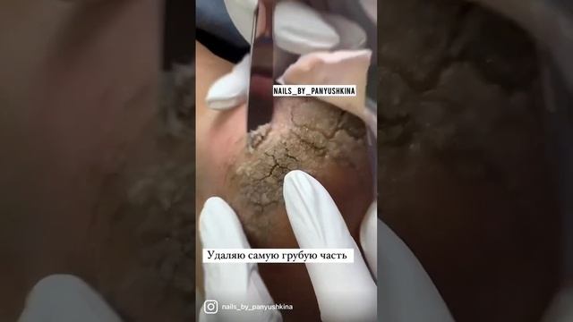 Обработка трещин #аппаратныйпедикюр #педикюр #подология #трещинынапятках #стопы #грибок #pedicure смотреть онлайн