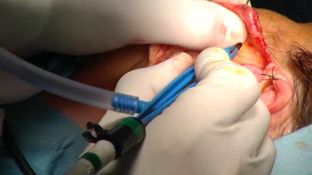 Dr Vandeputte Опухоль слюнной железы смотреть онлайн