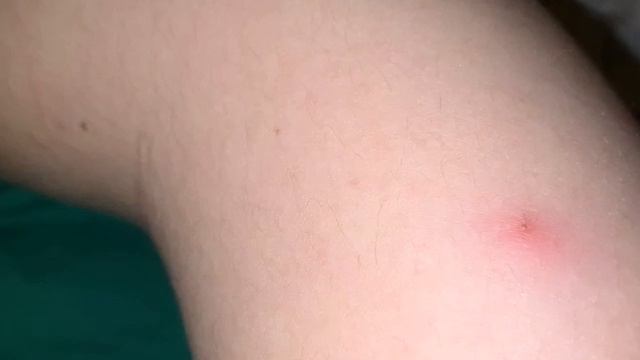 FURUNKUL( CHIQON )SABABLARI UY SHAROITIDA DAVOLASH USULLARI