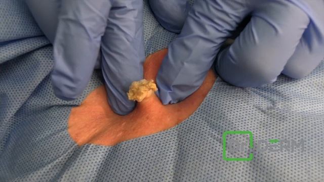 The Flawless Cyst | Dr. Derm смотреть онлайн