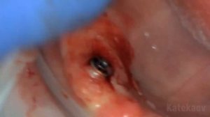 Установка формирователя десны